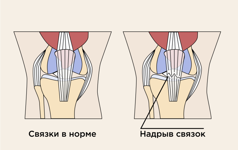 Повреждение связок колена