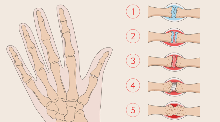 Изменение формы пальцев при ревматоидном артрите